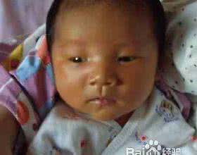 痘印快速有效治疗方法 黄疸的治疗方法 怎样快速治疗黄疸