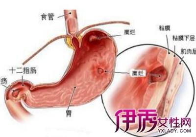 胃病的症状表现有哪些 胃病的症状 胃病有哪些表现