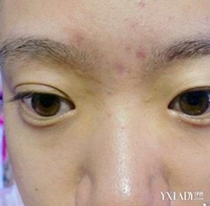 眉毛长痘痘是什么原因 【眉毛上长痘痘是什么原因】痘痘经常长在两眉毛之间或者眉毛里面是什么原因？_眉毛上长痘痘是什么原因