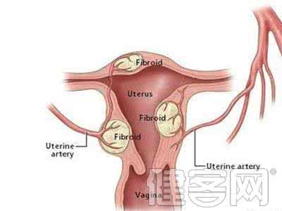 子宫肌瘤吃什么保健品 子宫肌瘤吃什么保健品 女性子宫壁薄的日常保健