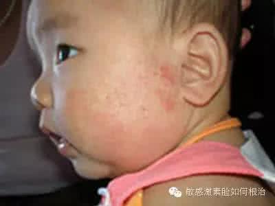 小儿湿疹症状图片 小儿湿疹的症状 常见的小儿湿疹症状表现