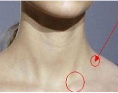 浅表淋巴结肿大特征 浅表淋巴结肿大特征 如何调理浅表淋巴结肿大