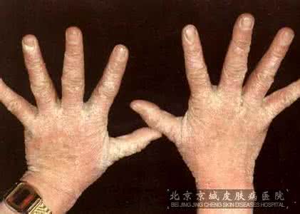 治疗疥疮最快的方法 疥疮是怎么引起的