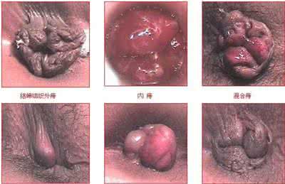 痔疮疼怎么办 【痔疮疼怎么办】痔疮很疼怎么办_痔疮疼怎么办