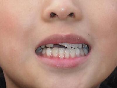 嘴上上火起泡一晚消除 上火嘴上起水泡 上火导致嘴上出现水泡 如何才能消除水泡