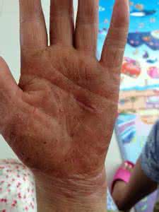 湿疹皮炎偏方治疗方法 湿疹皮炎偏方治疗方法 湿疹中医治疗方法 皮炎湿疹的十个偏方