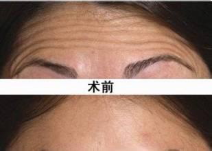 激光去除抬头纹价格 激光去除抬头纹价格 激光去除抬头纹是怎么回事