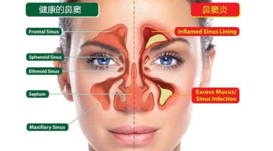 鼻涕颜色代表什么症状 鼻涕颜色代表什么?