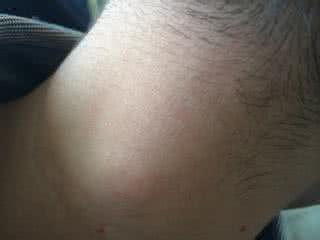 脖子右侧有肿块但不痛 脖子右侧有肿块但不痛 乳房肿块 别以为不痛就没事