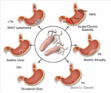 幽门螺杆菌克星食物 幽门螺杆菌的克星食物 吃什么伤肾脏？伤害肾脏的克星食物有哪些