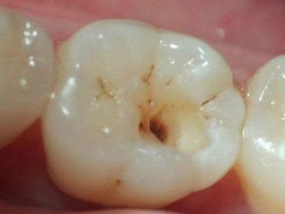 蛀牙有什么症状 蛀牙有哪些症状?