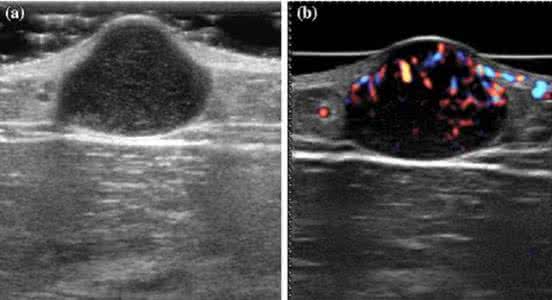 乳腺超声 乳腺癌漏诊 步步惊心：超声漏诊的乳腺癌