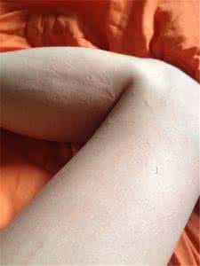 荨麻疹吃什么药最有效 荨麻疹是怎么引起的