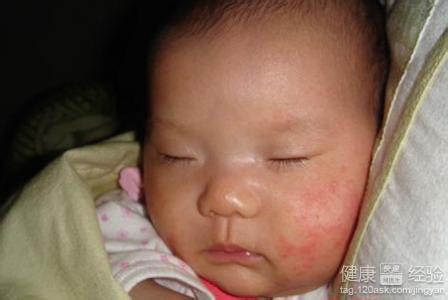 婴儿干性湿疹症状图片 婴儿干性湿疹怎么护理 婴儿出现湿疹症状，我有我的护理方法