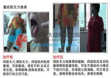 重症肌无力分类 重症肌无力的分类是怎样的