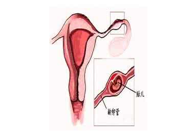 输卵管通水手术方法 输卵管通水手术方法 宫外孕术后做输卵管通水测试