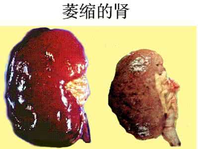 双肾萎缩是尿毒症吗 尿毒症肾萎缩古验方一则*