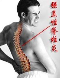 僵直性脊椎炎 僵直性脊椎炎 带你了解什么是脊椎炎