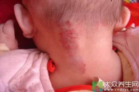 血管瘤形成的原因 血管瘤是怎么形成的 4大原因引起血管瘤