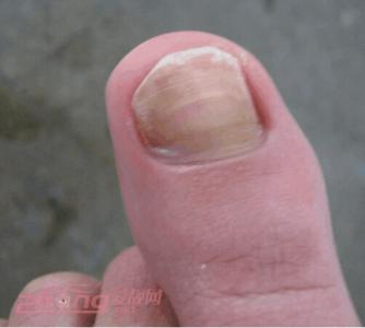 轻微灰指甲的症状图片 灰指甲 轻微灰指甲图片