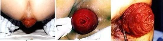 脱肛的最佳治疗方法 脱肛是怎么回事 治疗脱肛的方法有哪些