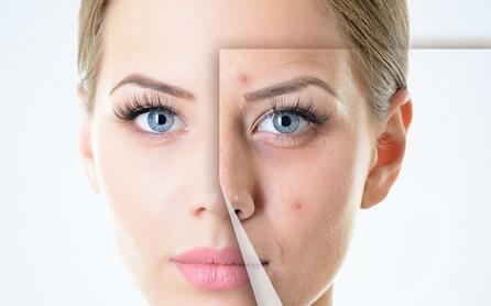 去痘印最有效的方法 去痘印的方法