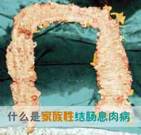 结肠息肉的病因 结肠息肉病因 结肠息肉的病因有哪些? 怎样预防结肠息肉?