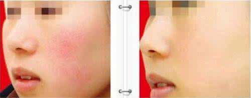 去除面部红血丝偏方 祛除面部红血丝 去除面部红血丝