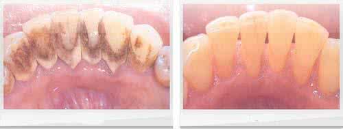 牙周炎的治疗方法 牙周炎的治疗 这一方法治疗牙周炎效果好