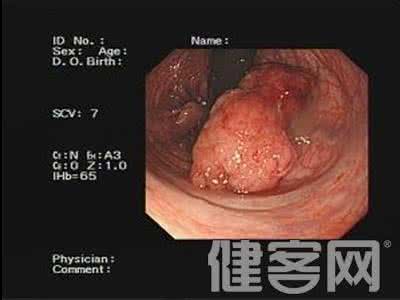 痔疮会变成直肠癌吗 直肠癌经常伪装成痔疮，如何把它揪出来？ 一点资讯