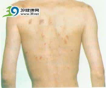 艾滋病人身上会长什么 艾滋病人身上有什么?