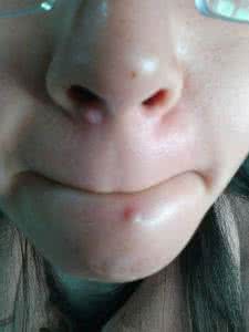 下巴长痘痘怎么去除 下巴上长痘痘是什么原因