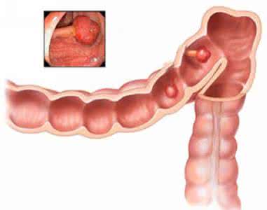 直肠癌晚期什么症状 直肠癌血液里什么症状？