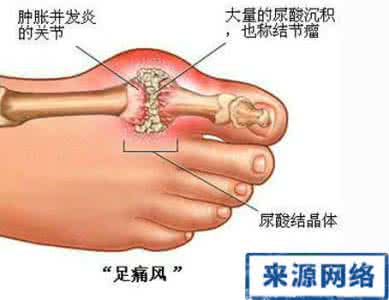 上海长江医院痛风科 医学传灯-痛风