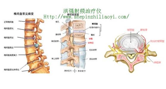 针灸能够治疗腰突症吗 筋针治疗腰突症（后续）