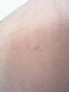 大腿上有红点不痛不痒 腿上有红点不痛不痒 腿上有红点