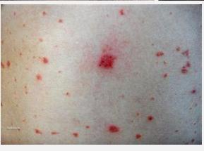 主治寻常型牛皮鲜 寻常型牛皮鲜症状图片 寻常型牛皮癣各时期的一些症状