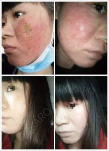 糖皮质激素类药物 激素类药物 激素类药物治疗牛皮癣怎么样？