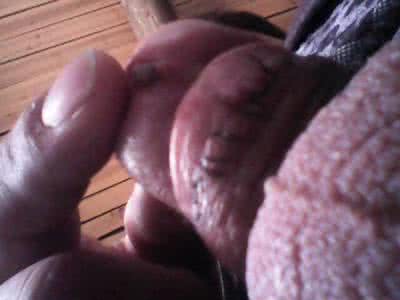 包皮手术 多大可以做包皮手术