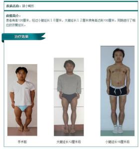 o型腿会影响身高吗 o型腿会影响身高吗 小孩O型腿影响身高吗？