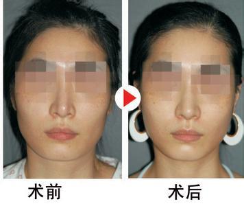 磨颧骨手术过程怎样 磨颧骨手术过程 颧骨增高怎么进行手术过程