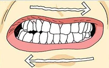 睡觉磨牙是什么原因 睡觉磨牙是什么原因 睡觉磨牙是什么原因 不同人睡觉磨牙原因