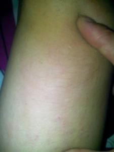 为什么吃河虾会过敏 吃河虾会过敏吗 河虾会过敏吗？