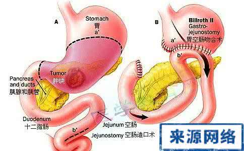 十二指肠溃疡的原因 十二指肠溃疡 十二指肠溃疡是什么原因