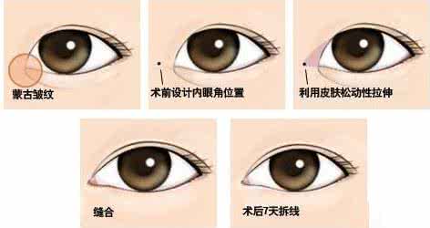 内眦赘皮和开眼角区别 内眦赘皮必须开眼角吗 做开眼角手术纠正内眦赘皮要注意什么?