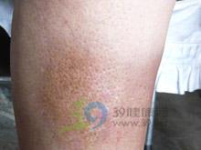 鼻咽癌3大体征7大症状 什么是褐黄病 褐黄病的症状体征与治疗