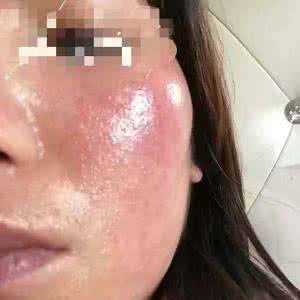 轻度激素脸能自愈吗 轻度激素脸能自愈吗？