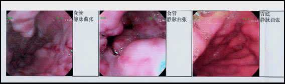 肝硬化胃底静脉曲张 土鳖虫治疗肝硬化、滑囊炎、静脉曲张