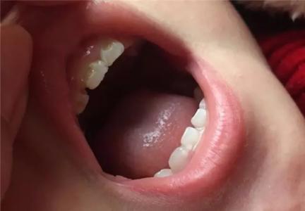 牙龈血管瘤图片 幼儿牙龈红肿图片 幼儿牙龈红肿怎么办