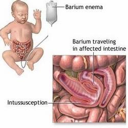 宝宝肠套叠症状 肠套叠怎样快速识别宝宝的症状